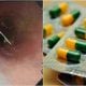 Plastic pill lodged in woman's throat