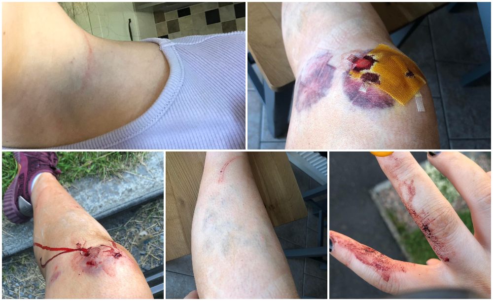 Injuries sustained in Darkley Forest dog attack